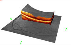 3D Ansicht Nervenfaser-Schichtdicke